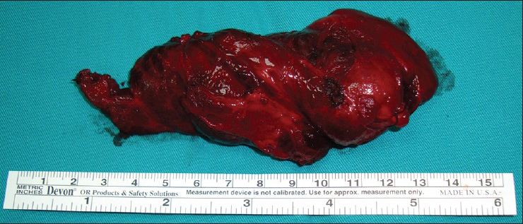 The appearance of the enlarged thyroid tissue (goiter) after the excision. The size of the goiter was 10 × 4 × 5 cm
